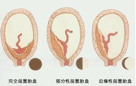 第306医院妇产科成功抢救一例胎盘早剥