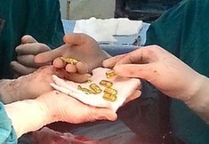 奇葩富商12根金條藏腹部