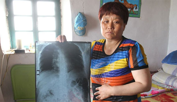 女子查出體內有5根繡花針