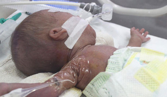 湖北1斤重早産兒成活 出生時僅有圓珠筆長