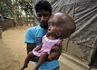 印度女童患脑积水 外形犹如外星人ET