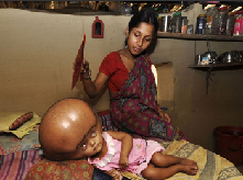 印度女童患腦積水外形猶如外星人