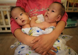 北京：連體女嬰被遺福利院 &ldquo;分身&rdquo;手術最快春節後進行