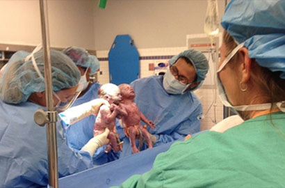 美罕見雙胞胎姐妹牽手出生