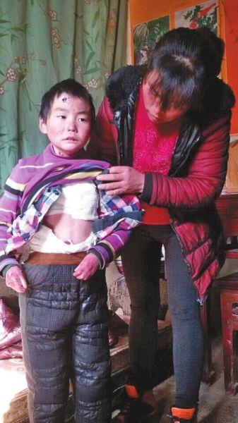 河南8岁男童患罕见病 全身皮肤一触碰即溃烂(图)