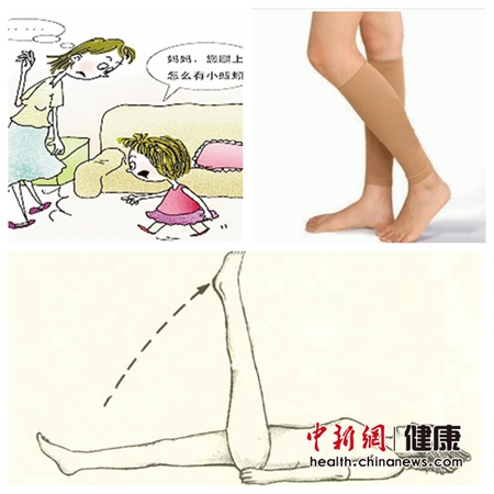 20%成年人会发生下肢静脉曲张久坐族要防“蚯蚓腿”