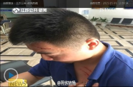 记者正常报道火灾遭殴打 全身多处严重划伤