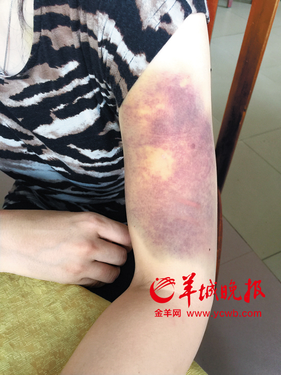 当事人向记者展示被殴打致淤青的手臂
