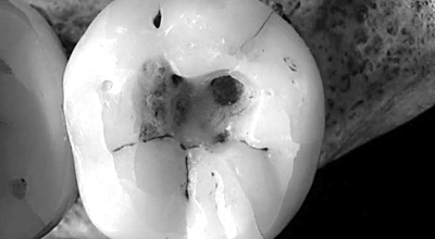 新研究揭示史前人类最早如何治疗蛀牙