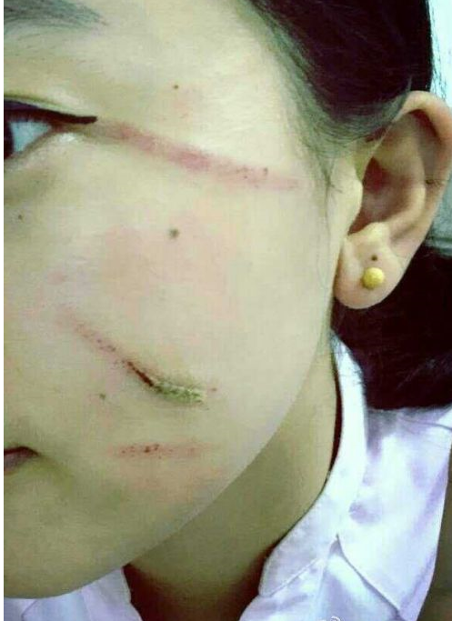 高铁乘务员被12名乘客殴打 脸和胳膊有多处伤口