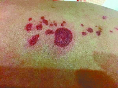 月饼盒里掉出干冰 瞬间冻伤女子双腿(图)