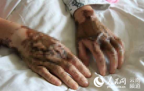 李汶蔚手背也被大面积灼伤。(人民网 虎遵会 摄)