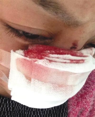 浙江一女子遭家暴被割鼻基本靠嘴呼吸 丈夫在逃