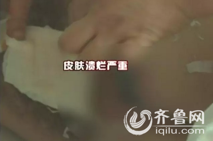 何大姐不但没治好病，身上也因为艾灸烫了水泡，导致遍体鳞伤。