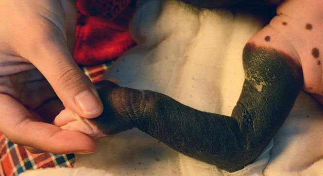 河北兽皮痣女婴亟待救助