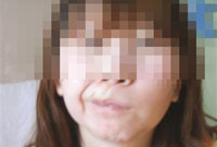 赴韩整形成歪嘴