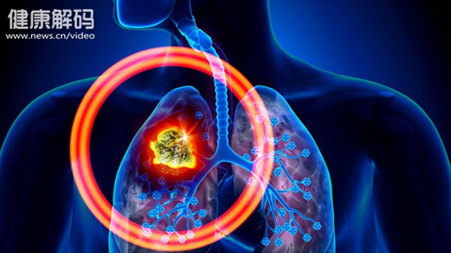 【健康解码】肺结核肺部感染是致癌诱因吗？