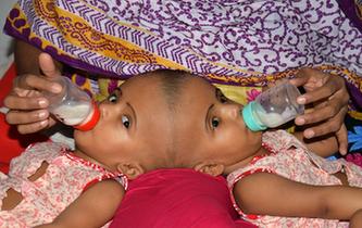孟加拉國頭部連體女嬰將準備接受分離手術