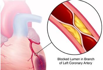 心梗救治要抓住&ldquo;黄金时间&rdquo;