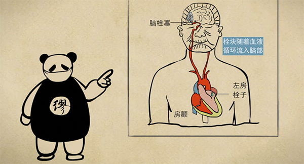 高血压、高血糖和高血脂，这三大危险因素是导致脑中风的一个非常重要的原因。