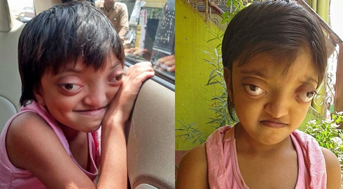 印度女孩患罕見病長”青蛙眼“ 飽受痛苦欺淩