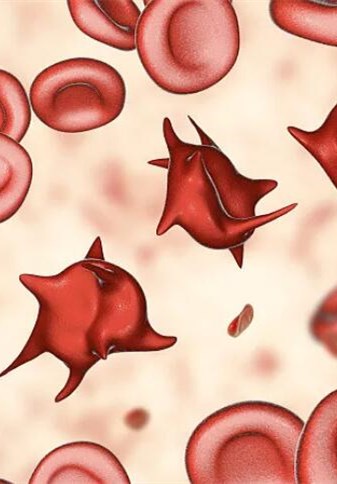 【健康解码】脊髓血管畸形会对身体造成什么危害？