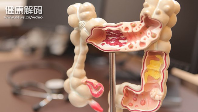 【健康解码】结直肠癌的早期症状是什么？