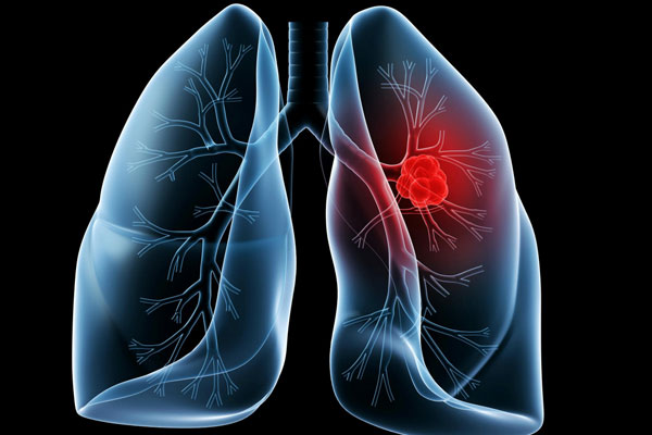 【健康解码】早期肺癌&ldquo;弱爆了&rdquo;