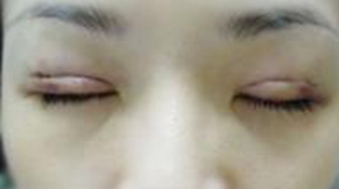 暗訪微整形亂象 用雞腿練習雙眼皮整形