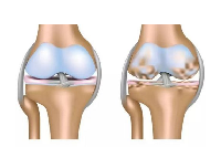 【健康解碼】你的膝關節也會咔咔作響嗎？