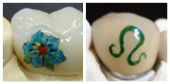 &ldquo;牙齿纹身&rdquo;成潮流：疼痛感小可保存多年（图）