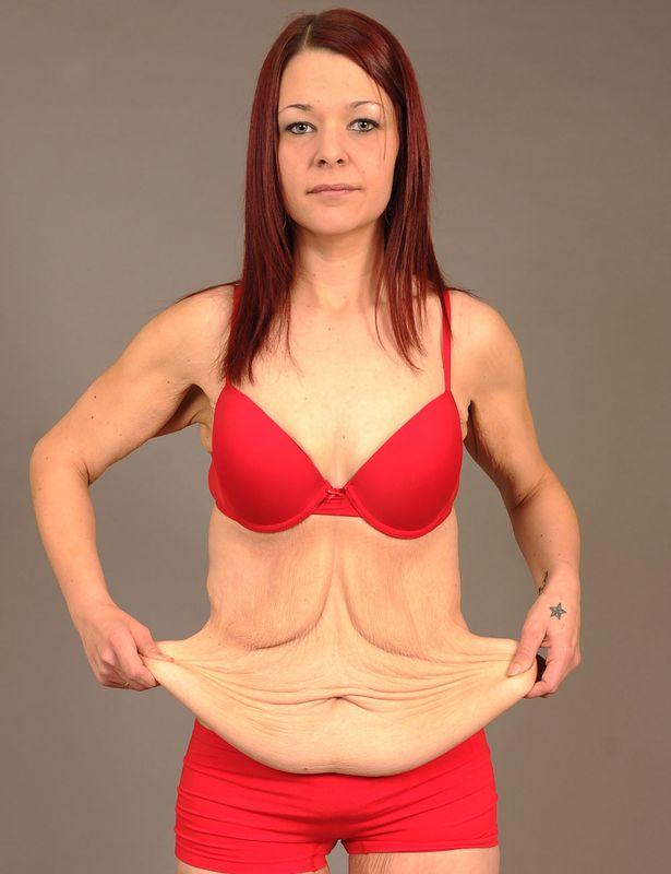 英国女子为婚礼狂减114斤致皮肤松垮如老妇