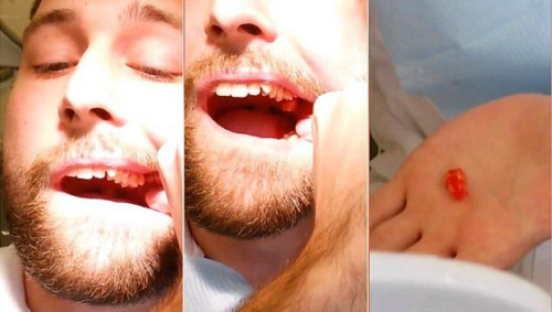 医生生病谁来治？实习牙医&ldquo;自己智齿自己拔&rdquo;