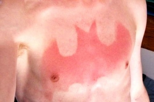 国外流行&ldquo;晒伤纹身&rdquo;医生：当心晒出皮肤癌（图）