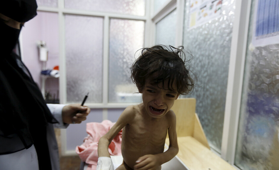 也门内战中营养不良的儿童(高清组图)