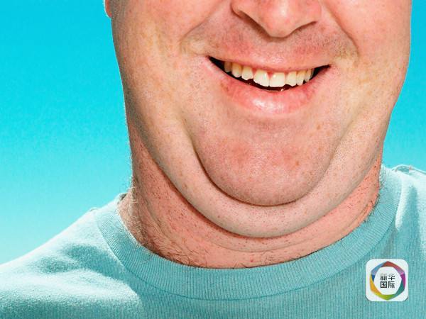 双下巴?不用开刀,打针消除