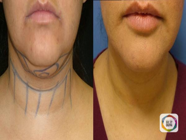 双下巴?不用开刀,打针消除