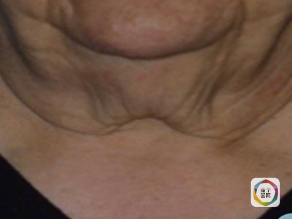 双下巴?不用开刀,打针消除