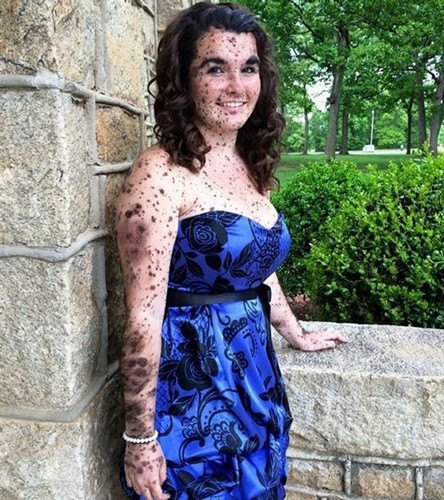 全身长黑斑遭讽&ldquo;斑点狗&rdquo;少女仍笑对人生（图）