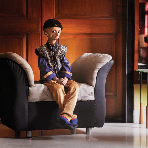 未老先衰:印度14岁男孩患早衰症体重仅为25斤