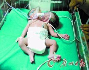 孟加拉国再现双头婴儿引围观 盘点全球双头婴事件(图)