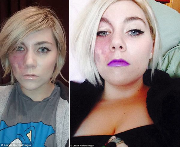 勇敢又美丽！英&ldquo;胎记女孩&rdquo;晒素颜自拍获十万网友点赞