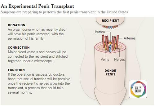 美国首例阴茎移植手术或可生儿育女 全球已有
