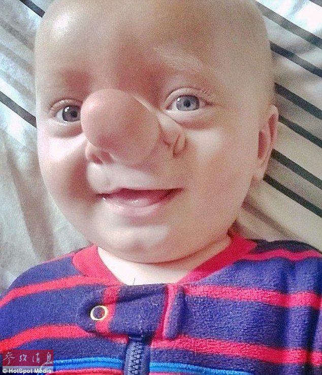英国婴儿天生缺陷神似匹诺曹