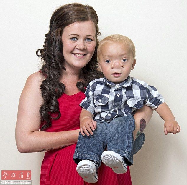 英国婴儿天生缺陷神似匹诺曹