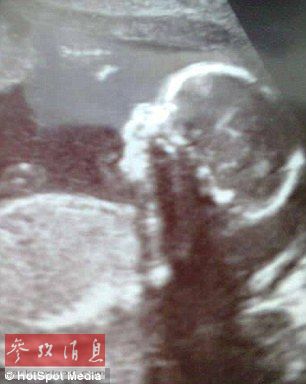 英国婴儿天生缺陷神似匹诺曹