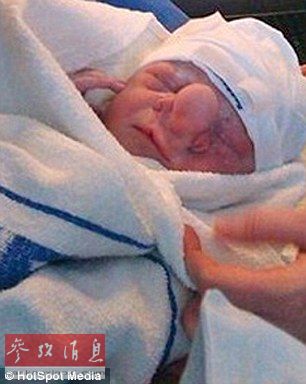 英国婴儿天生缺陷神似匹诺曹