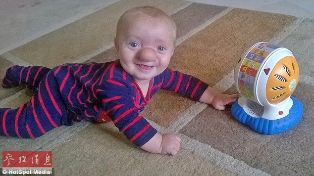 英国婴儿天生缺陷神似匹诺曹