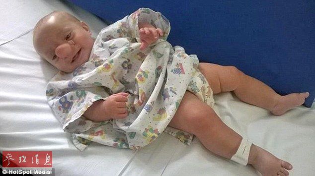 英国婴儿天生缺陷神似匹诺曹