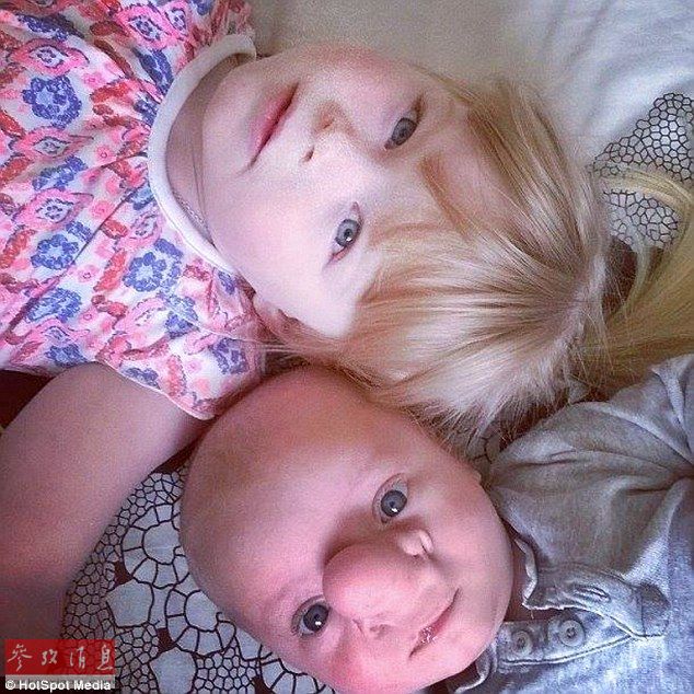 英国婴儿天生缺陷神似匹诺曹